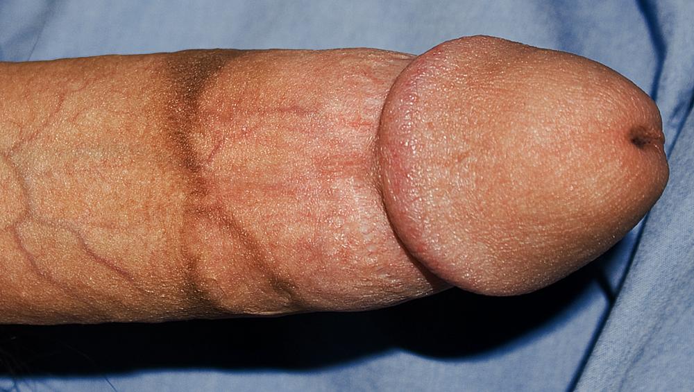Pénis circoncis Circoncision haute et serrée