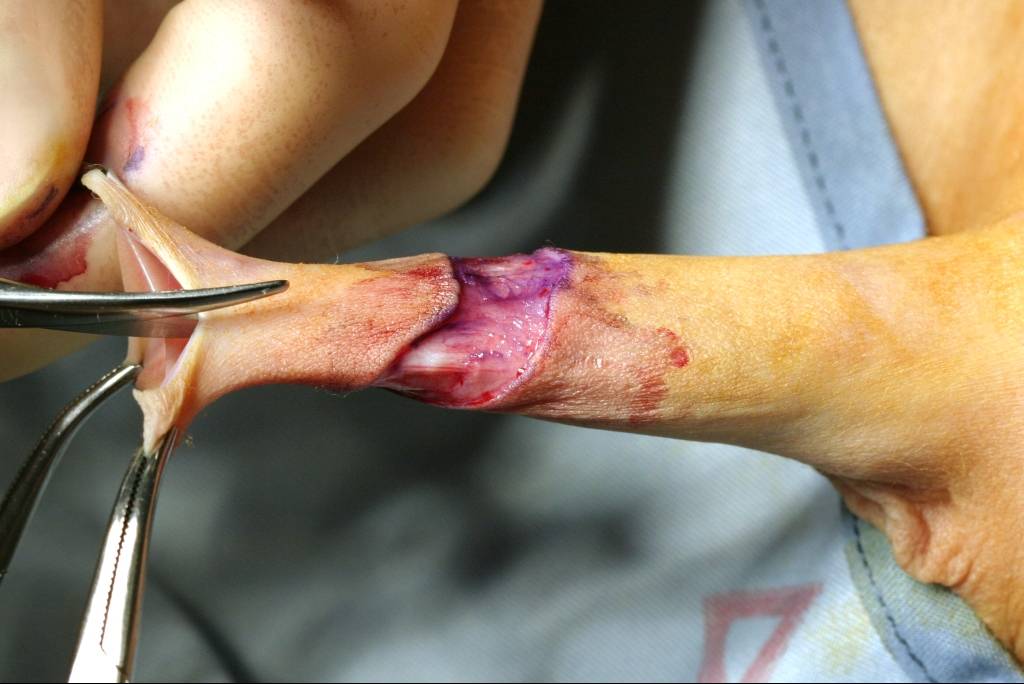 Photo circoncision masculine hôpital