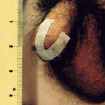 Méthode cross taping pour restaurer son prépuce