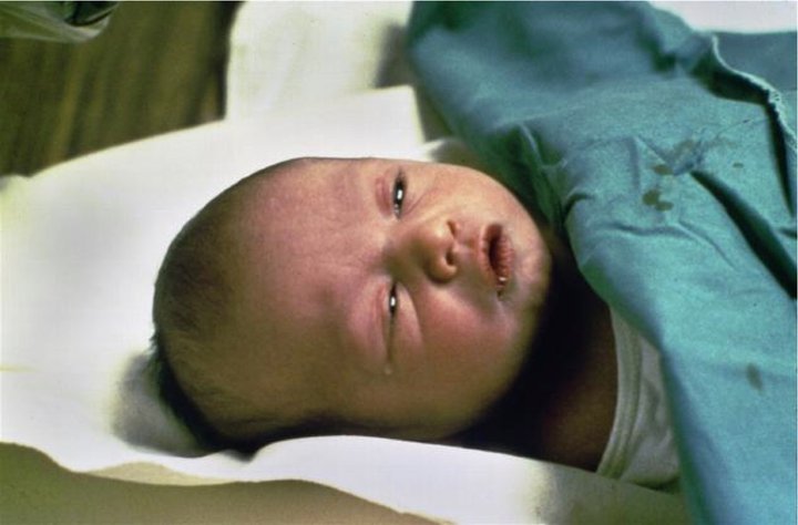 Bébé en état de choc psychologique après une circoncision