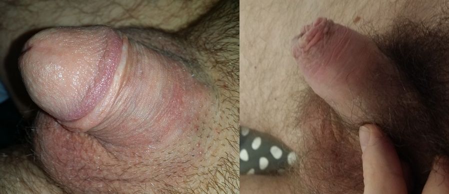 comparaison restauration prepuce couverture gland 23 mois