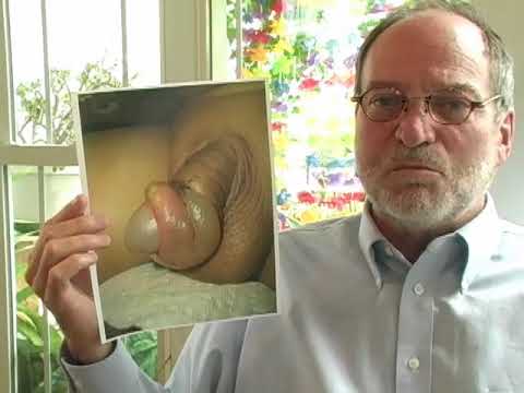 L'avocat John Geisheker montre une photo d'un paraphimosis provoqué par un décalottage forcé