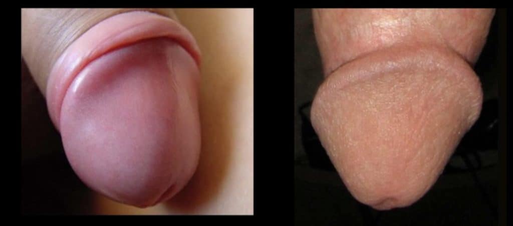 comparaison gland pénis avec et sans prépuce